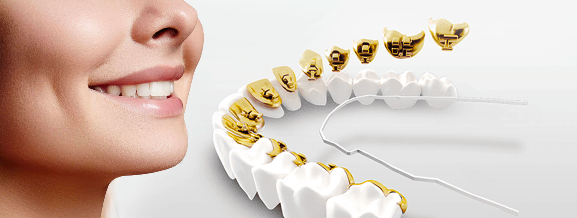 Lingual Ortodonti Lingual Ortodonti