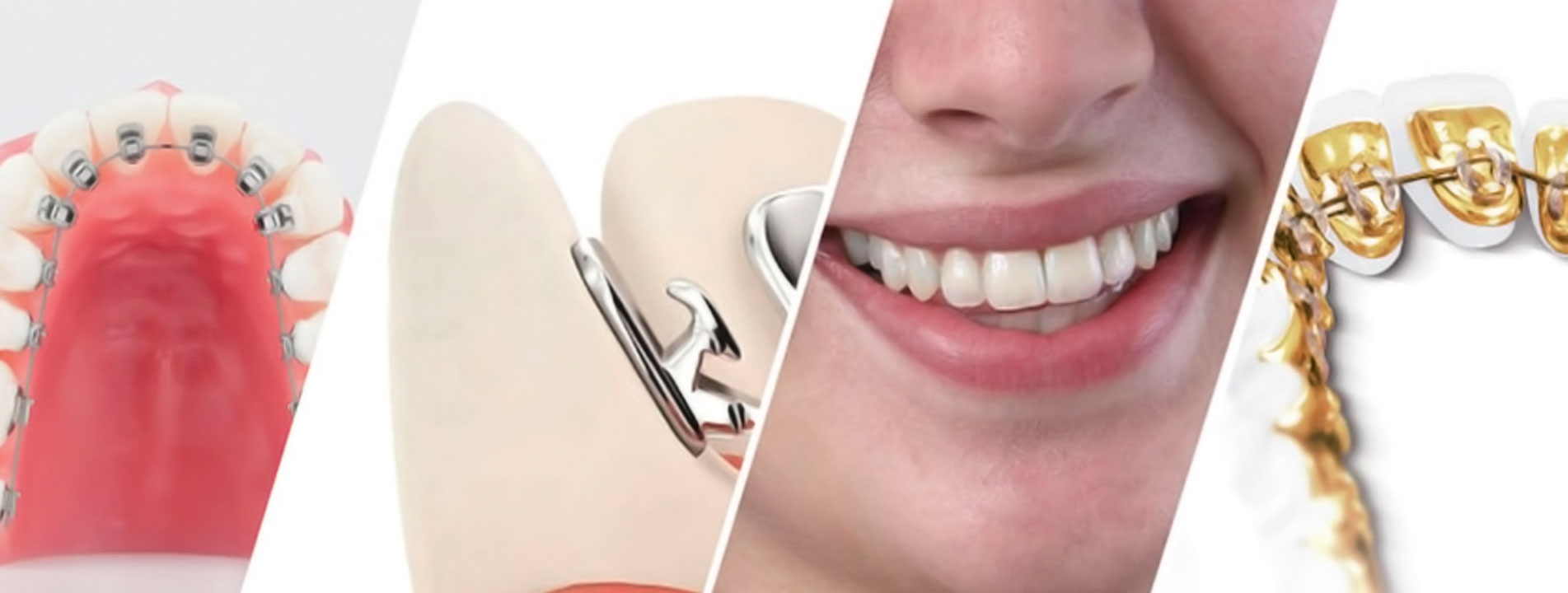 Ortodonti Nedir Ortodonti Nedir